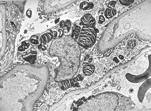 M,27y. | sea-blue histiocyte syndrome